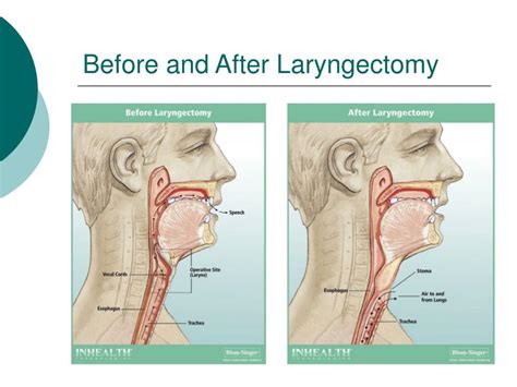 laryngectomy vula